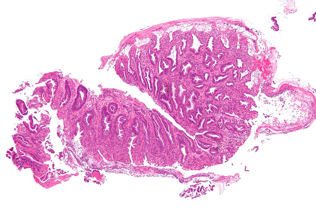 Like many painful medical conditions, colitis actually looks quite pretty under a microscope.